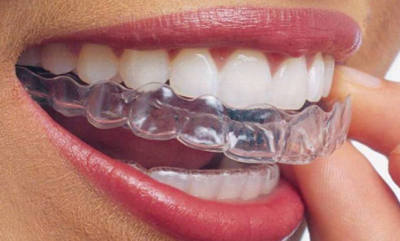 McClane Dentistry 2 mouthguard 400x241 1